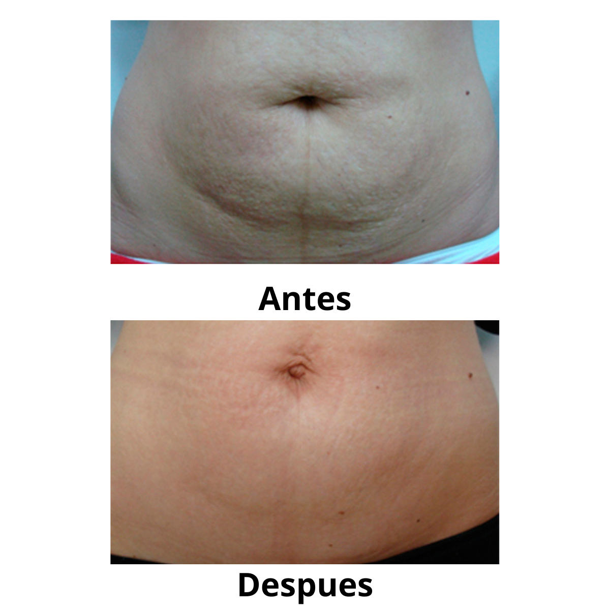 CREMA CORPORAL PARA MASAJES ANTI ESTRIAS